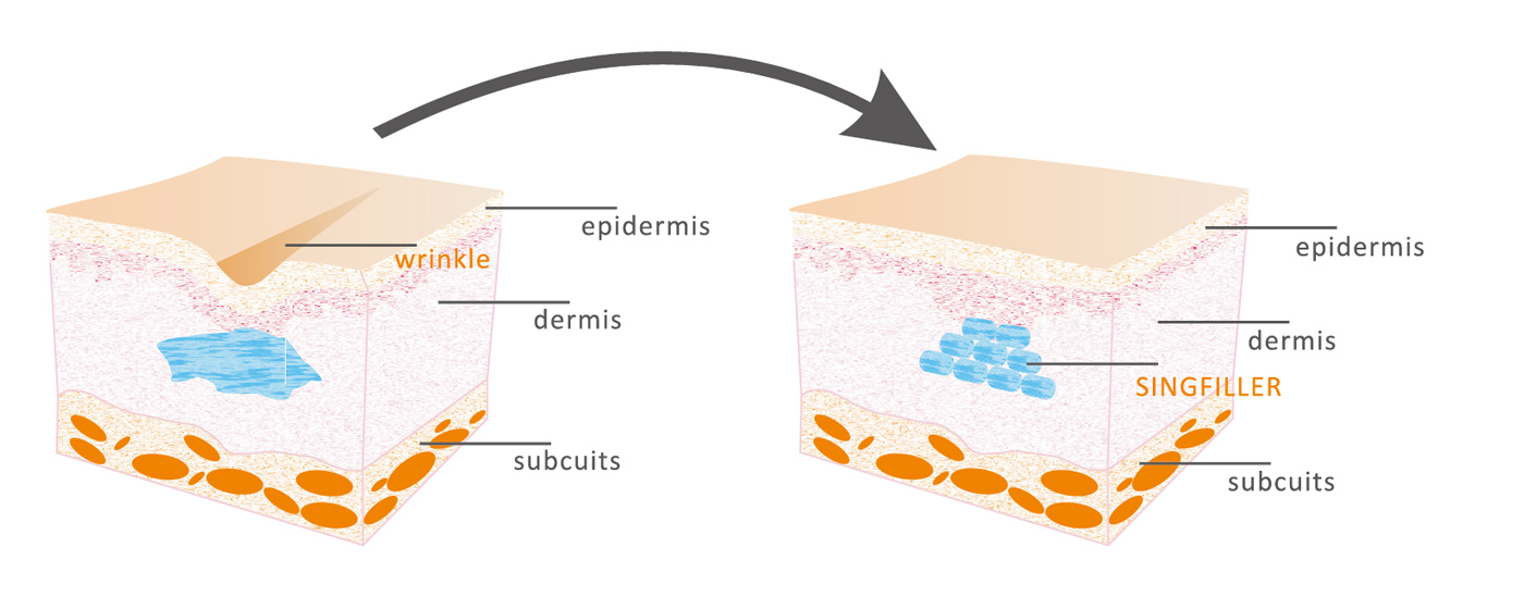 Singfiller® Bi-phasic Dermal Filler DEEPER