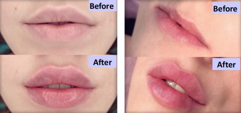 Hyaluronic Acid Lip Fillers