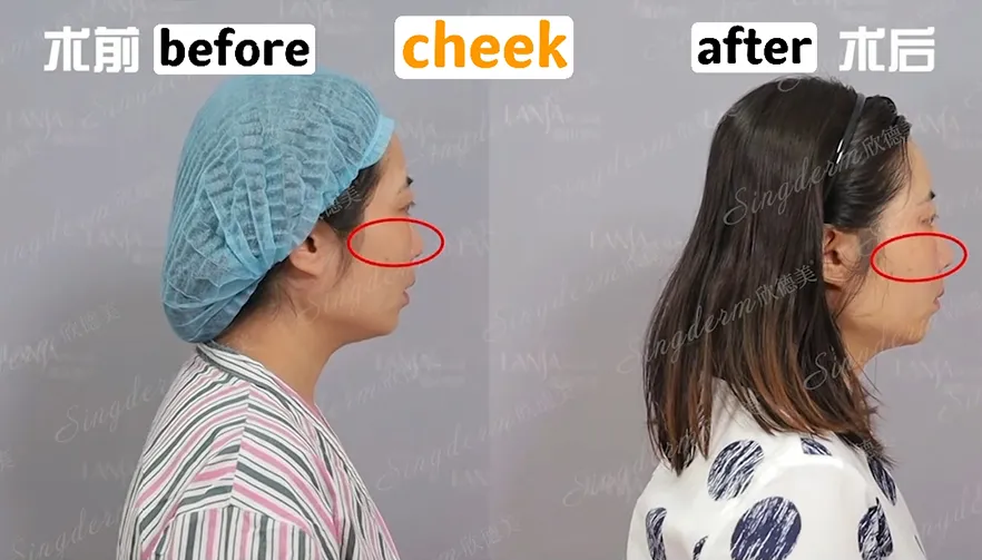 Singderm Cheek Injection Before & After