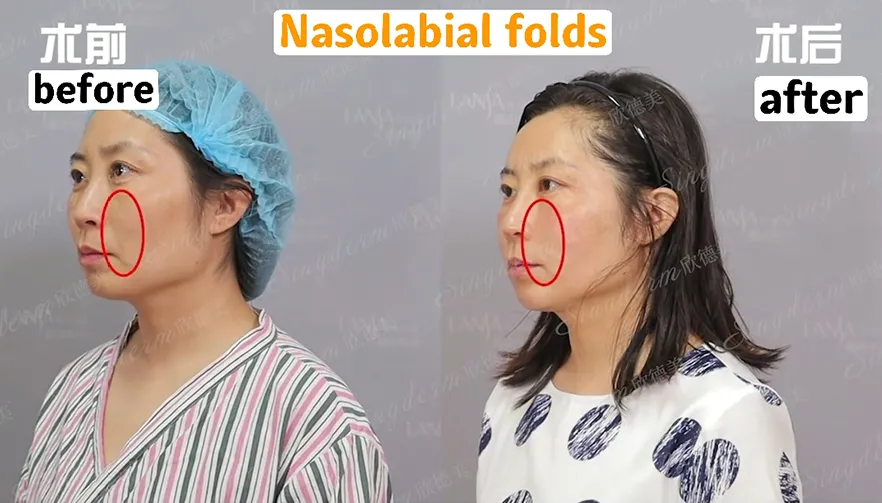 Singderm Nasolabial Folds Injection Before & After