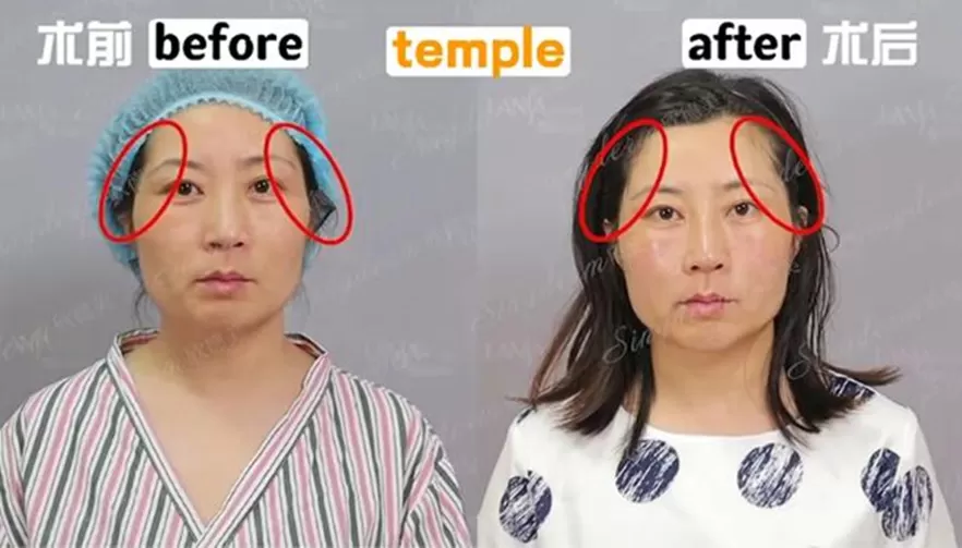 Singderm Temple Injection Before & After