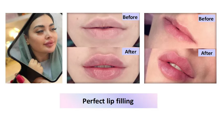 Singderm Lip Injection Before & After