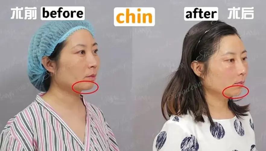 Singderm Chin Injection Before & After