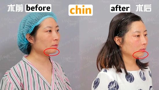 Singderm Chin Injection Before & After