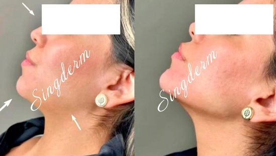 Singderm Jawline Refining