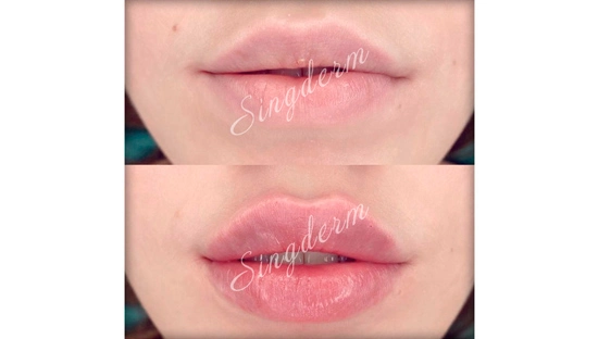 Singderm Lip Injection Before & After