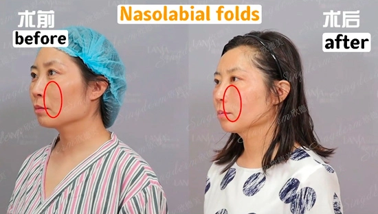 Singderm Nasolabial Folds Injection Before & After