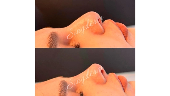 Singderm Nonsurgical Rhinoplasty