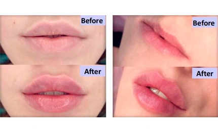 Hyaluronic Acid Lip Fillers: Everything You Need to Know