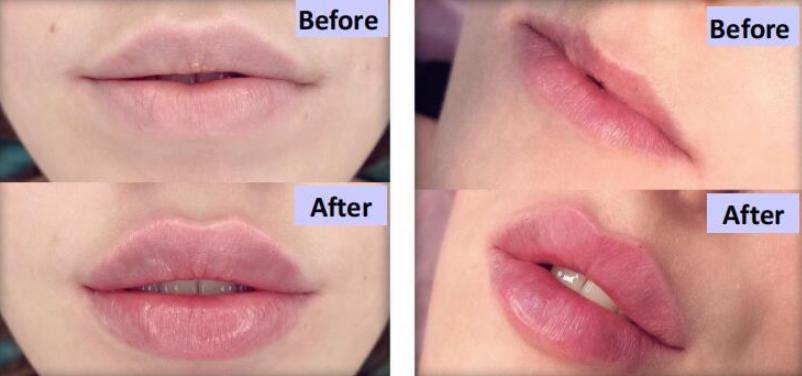 Hyaluronic Acid Lip Fillers: Everything You Need to Know