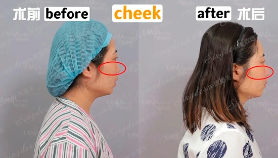 singderm-cheek-injection-before-after