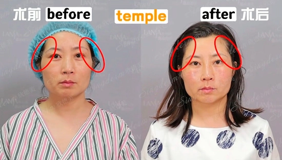 singderm-temple-injection-before-after