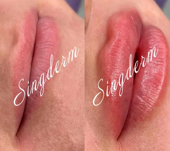 singderm lip dermal filler