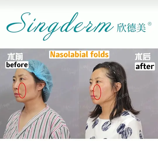 nasolabial-folds-singderm