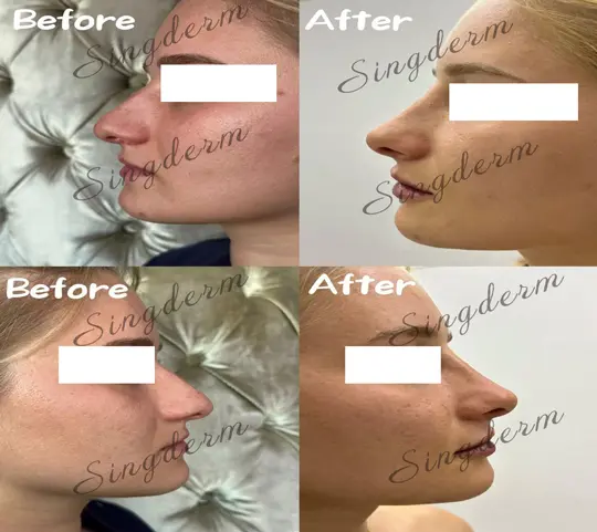 singderm dermal filler