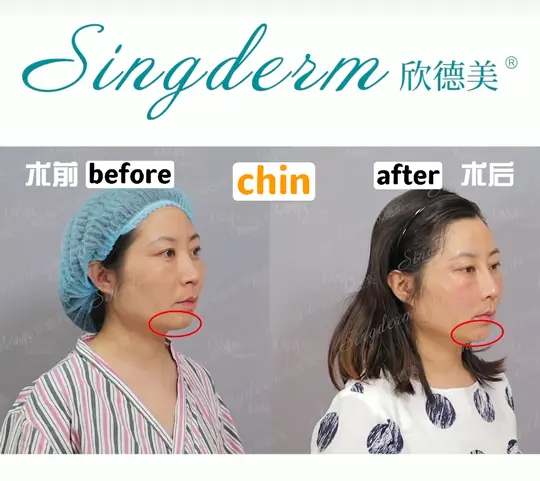 singderm chin