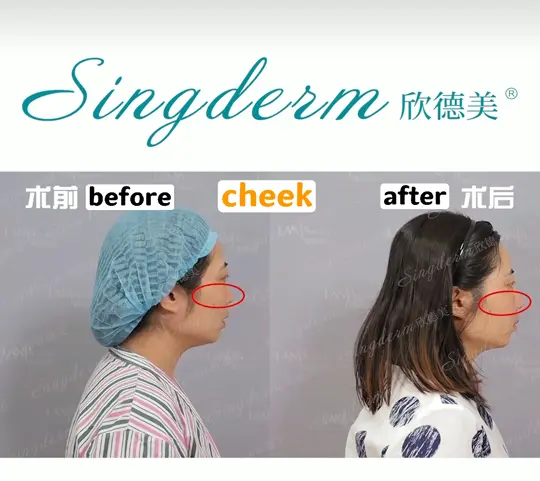 singerm cheek