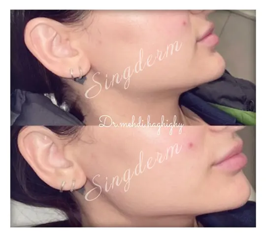 sinderm jawline refining