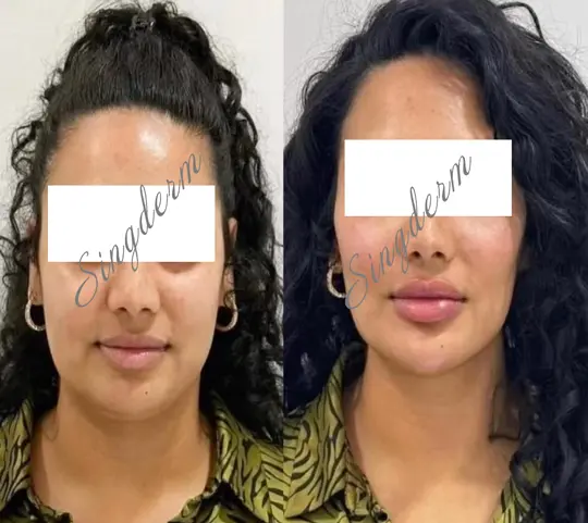 singerm dermal filler