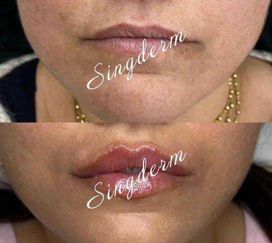 singderm dermal filler