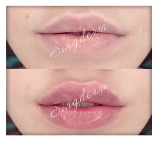 singderm lip filler