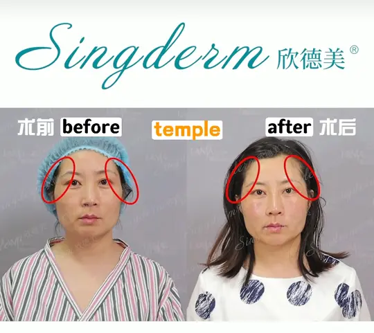 temple-singderm