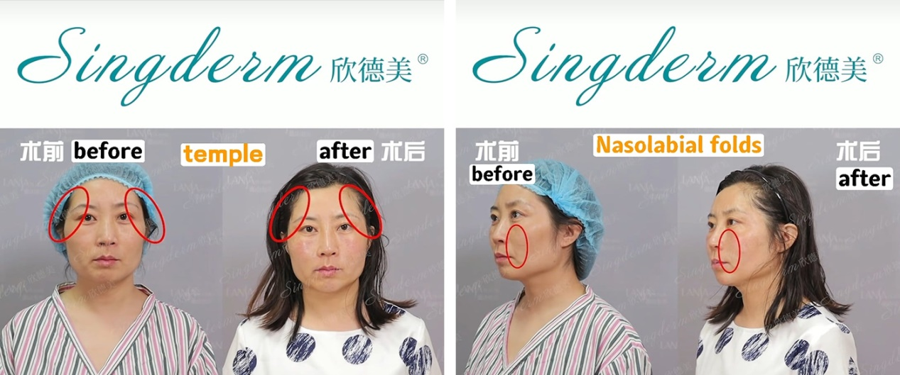 singderm dermal filler