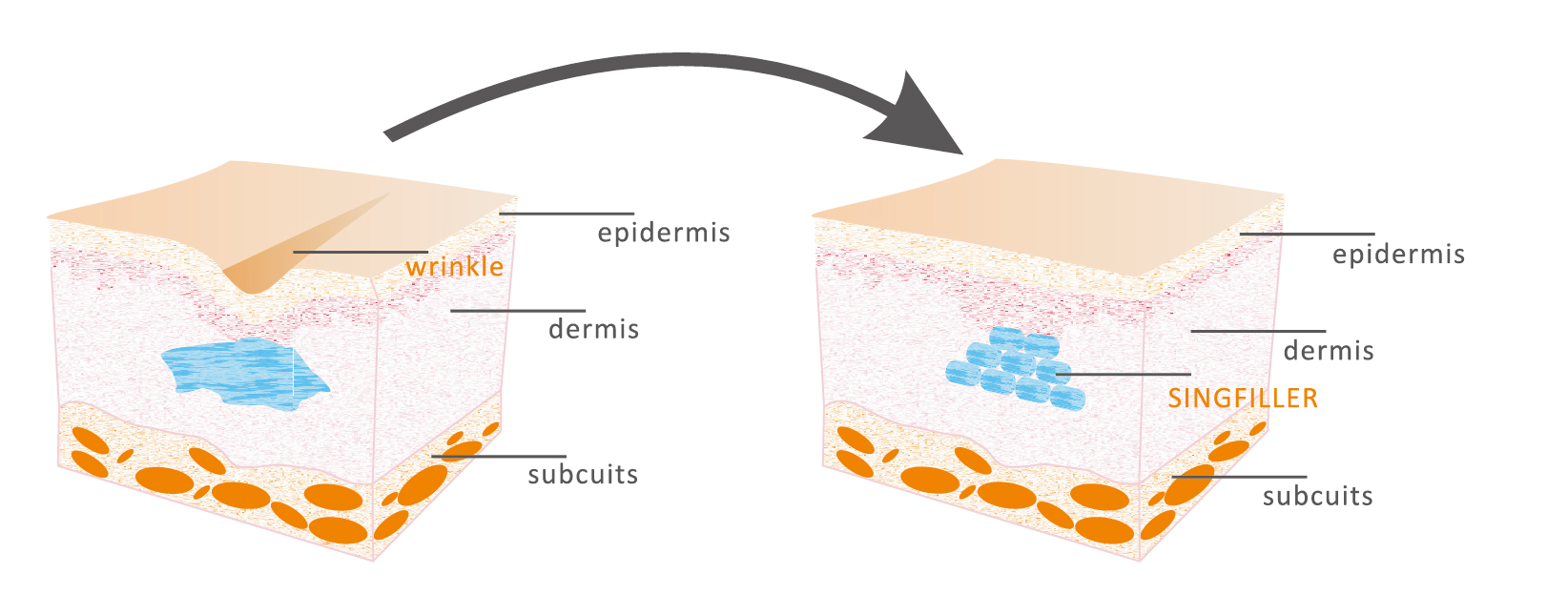 singfiller derm